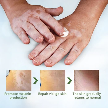 20g Hiina Meditsiini Vitiligo Salvi Pigment Melaniini Edendamine Liniment Nahk Valge laik Leukoplakia Haiguse Ravi